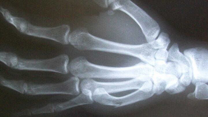 Para que serve o curso de fraturas?