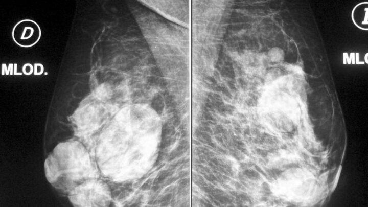 O que é mamografia?