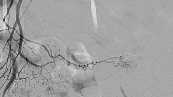 Obesidade e angiografia por Tomografia Computadorizada
