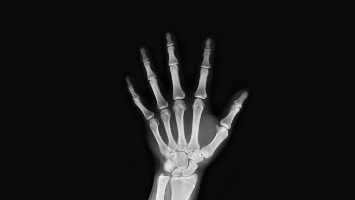 Análise de imagens e tratamento cirúrgico das fraturas diafisárias