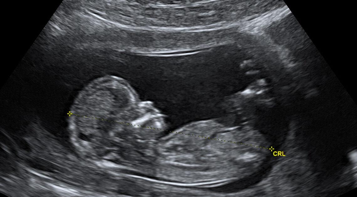 Ultrassonografia Pélvica