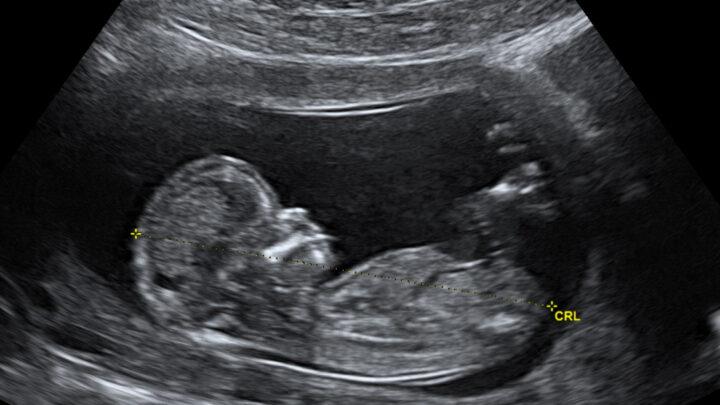 Ultrassonografia Pélvica