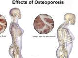 Como prevenir a osteoporose