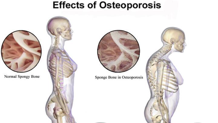 Como prevenir a osteoporose