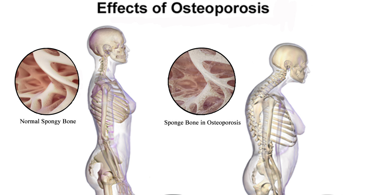 Como prevenir a osteoporose