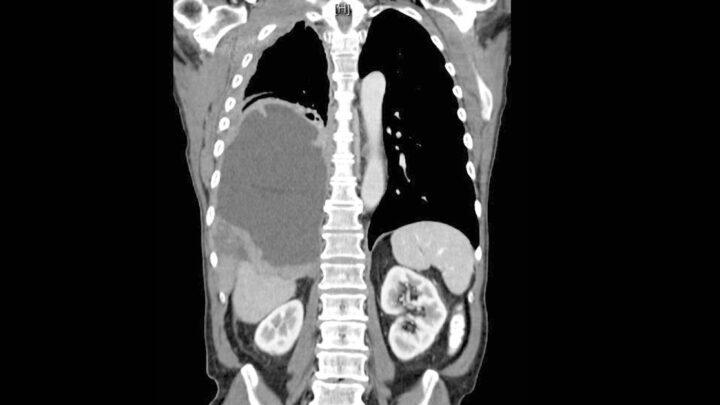 Custos do tratamento do mesotelioma