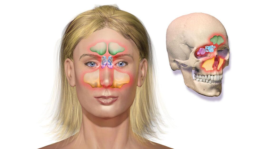 Sintomas e causas da sinusite