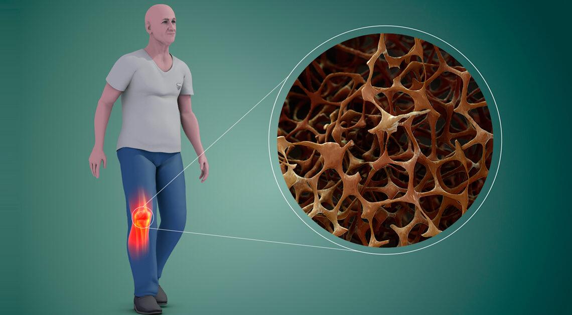 Densitometria Óssea e Osteoporose