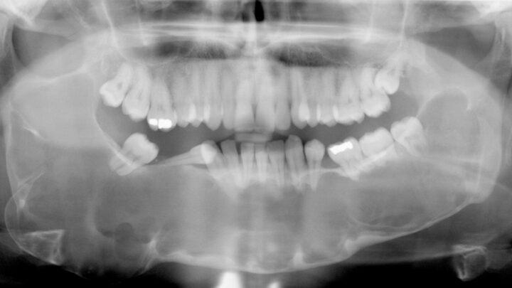 A importância de obter um raio X dental